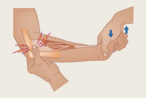 degenerazione tendinea