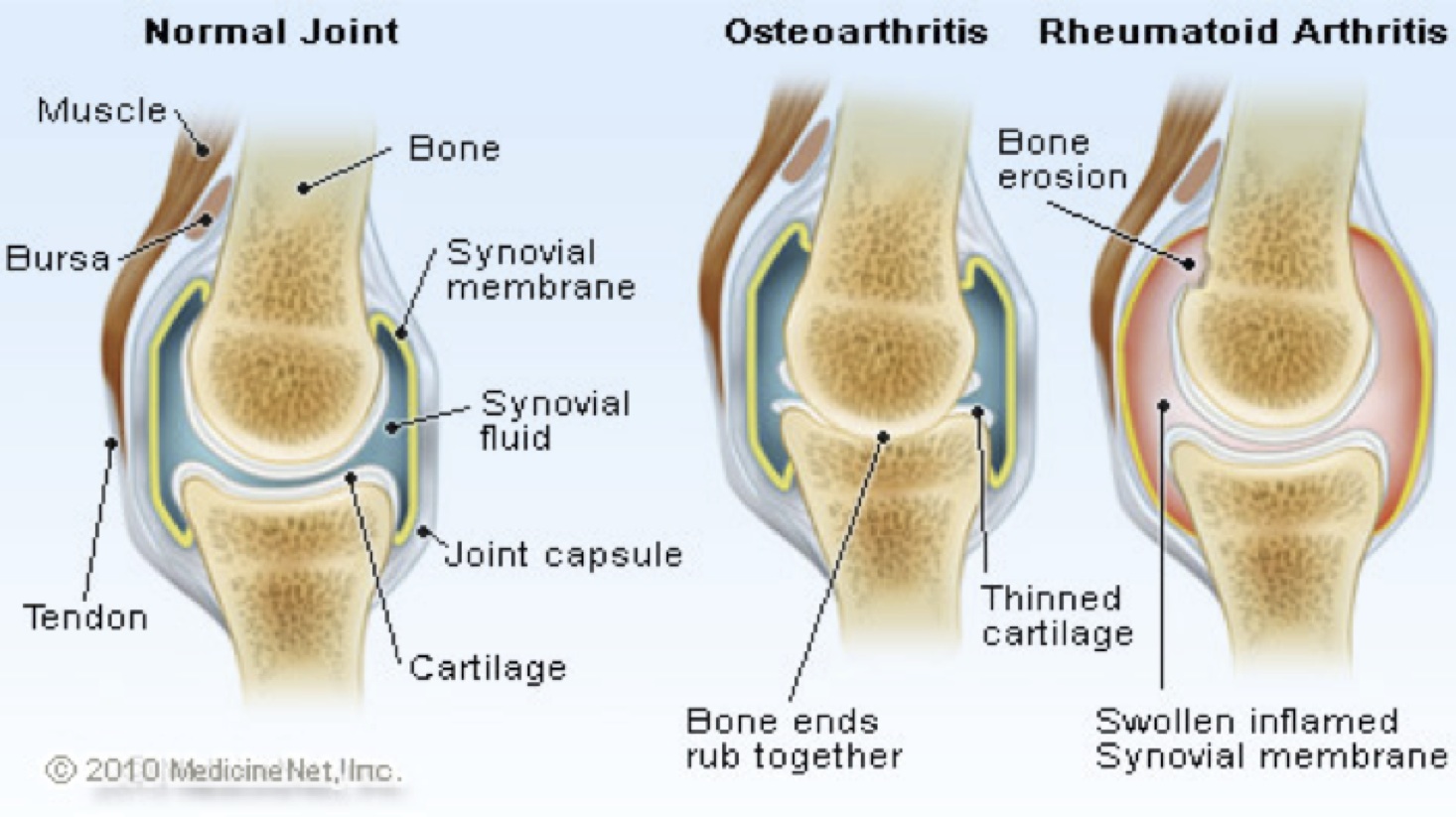 riduzione cartilagine articolare