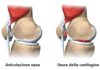 ginocchio-usura-cartilagine