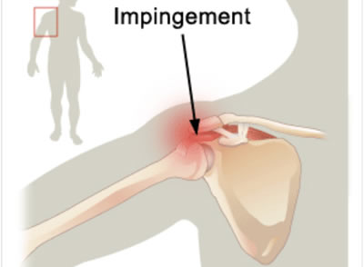 impingment subacromiale