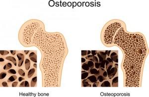 Osteoporosi