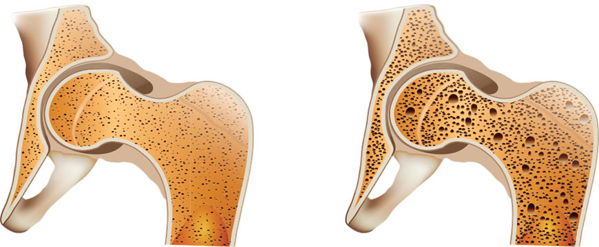 cibi acidi osteoporosi