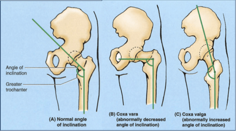 Angolo articolazione coxo-femorale