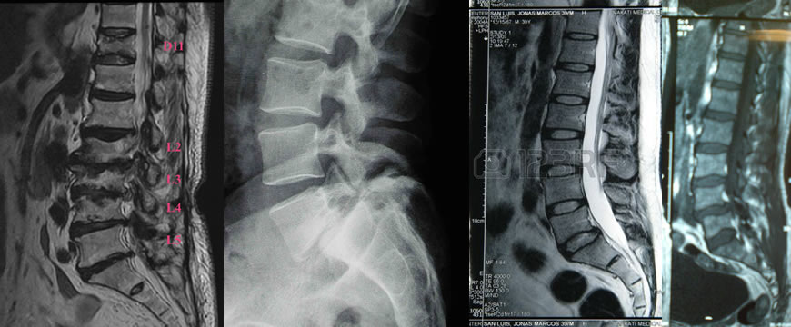 lombalgia radiografia