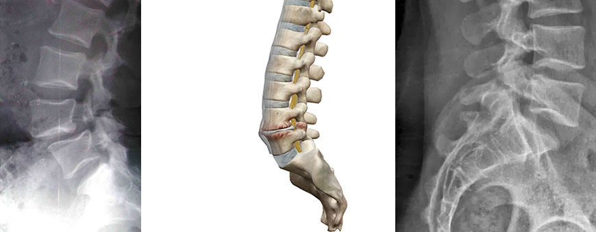 spondilolisi spondilolistesi