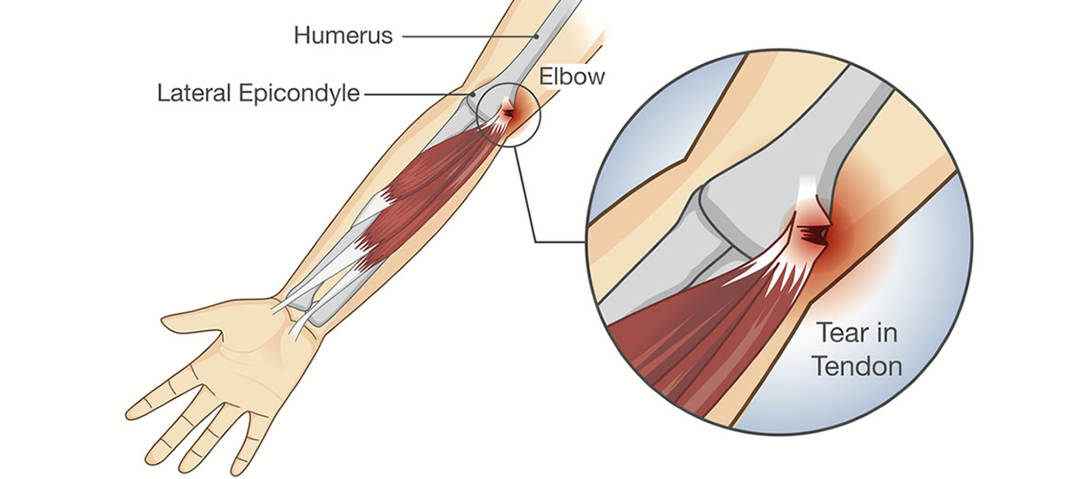 dolore al gomito epitrocleite