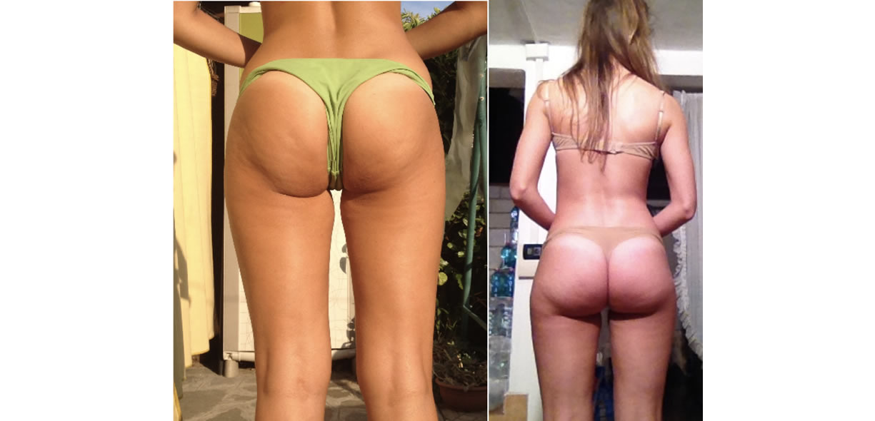 Cellulite un caso studio