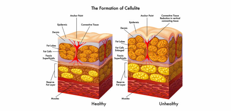 Cellulite Le Cause Pi Comuni Project InVictus