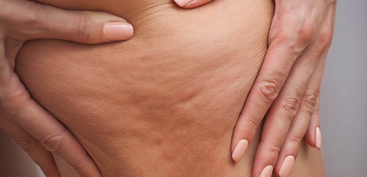 stadi della cellulite