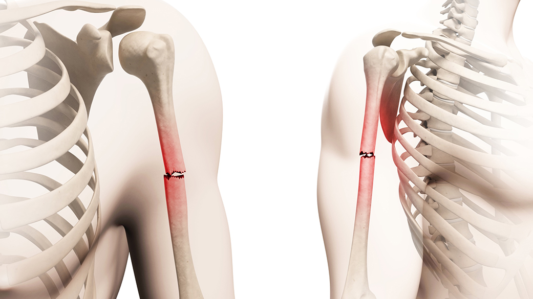 frattura dell'osso omero
