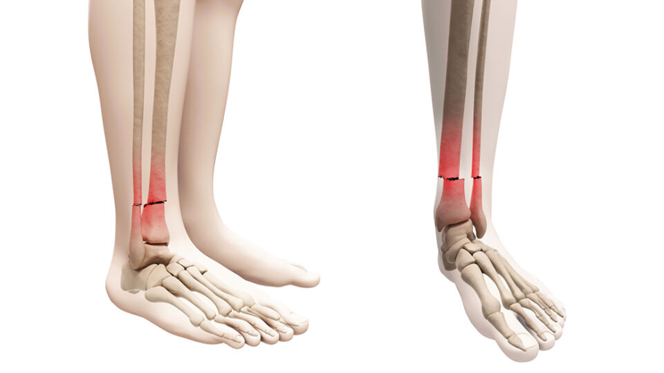 Si Trova All'estremità Inferiore Di Tibia E Perone Tibia: anatomia e dolore - Project inVictus