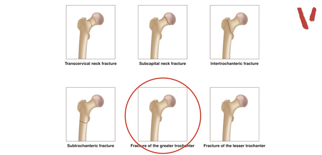 Frattura grande trocantere