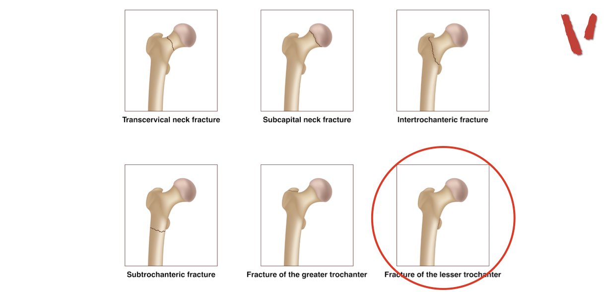 Frattura piccolo trocantere