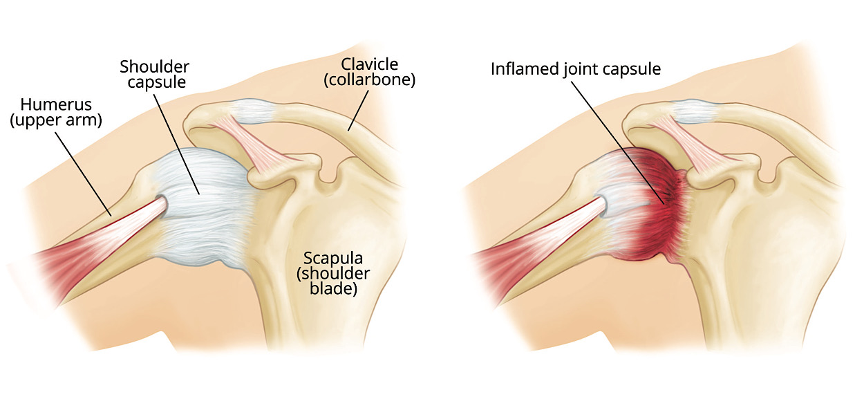 Frozen shoulder