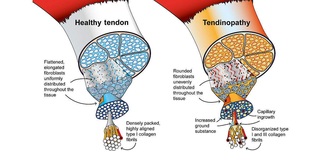 Tendinopatie