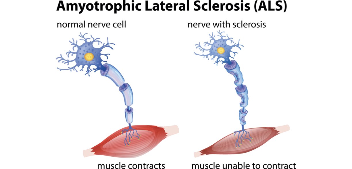 sclerosi laterale amiotrofica
