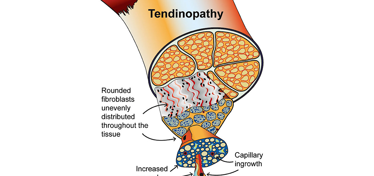 Tendinopatia 