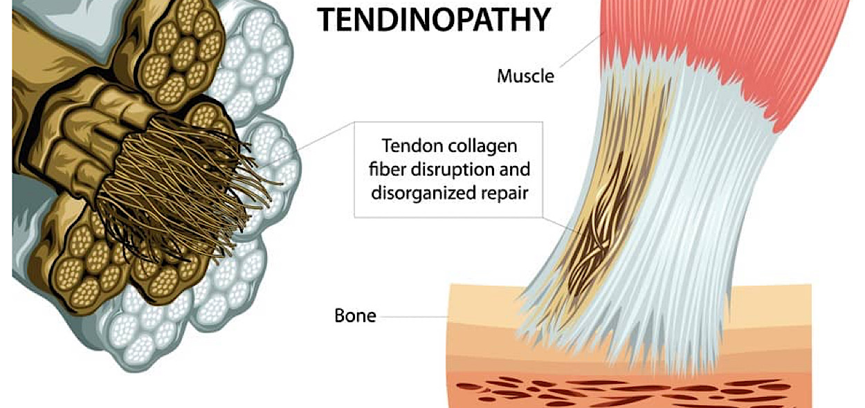 Tendinopatia