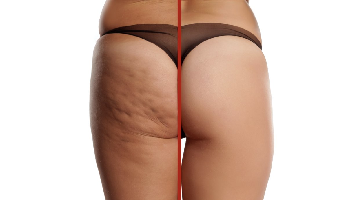 Cellulite cause e rimedi efficaci