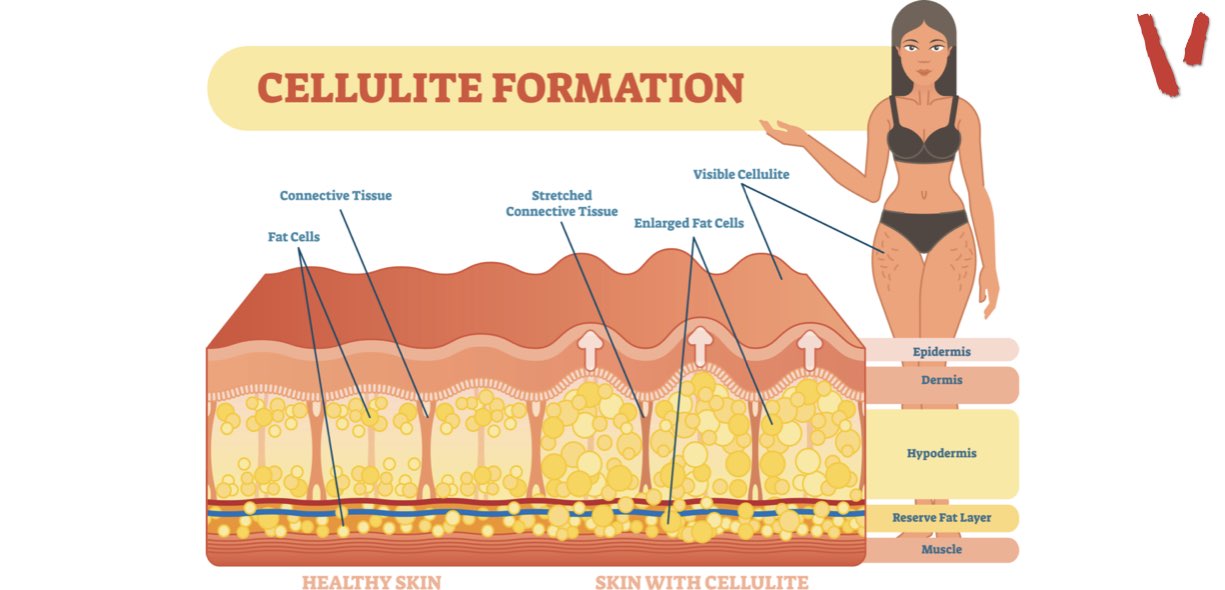 Cellulite Cause E Rimedi Efficaci Project InVictus