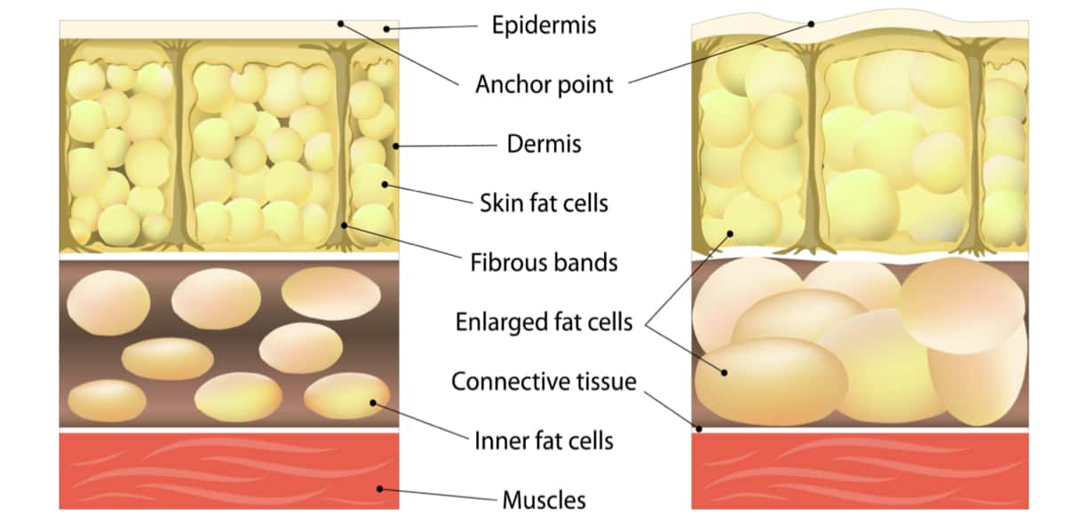 Gambe gonfie e cellulite