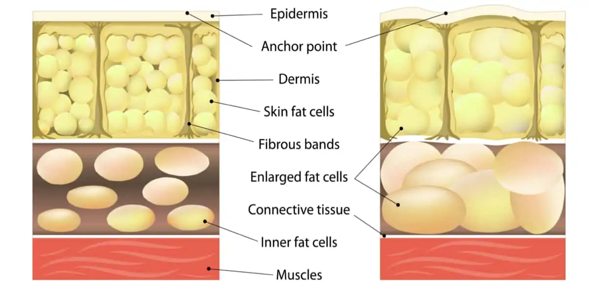 Gambe gonfie e cellulite