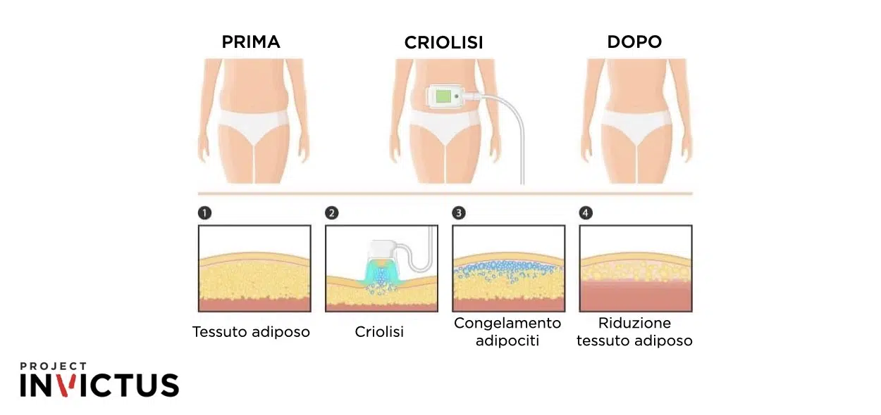 Criolisi