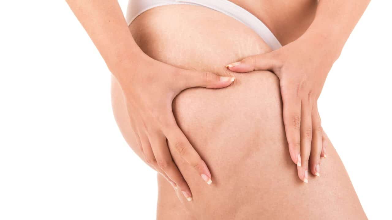 stadi cellulite donne